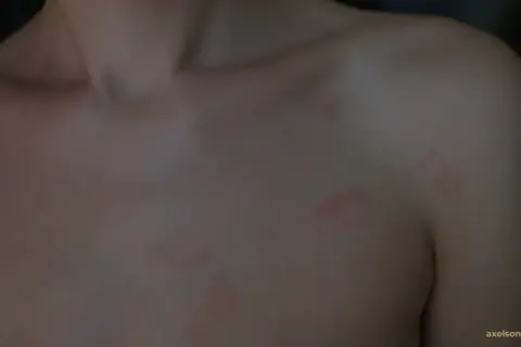 Hud med röda fläckar, möjligtvis stressutslag, på bröstet och axeln.