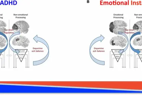 Diagram som visar hur dopamin och saliens påverkar emotionell och icke-emotionell bearbetning vid ADHD och emotionell instabilitet.