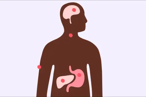 Illustration av en människa med markerade organ som hjärna, hals, mage och lever. Röda prickar visar var stress kan påverka kroppen, och frågan "kan man få feber av stress?" dyker upp.