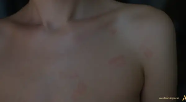 Hud med röda fläckar, möjligtvis stressutslag, på bröstet och axeln.