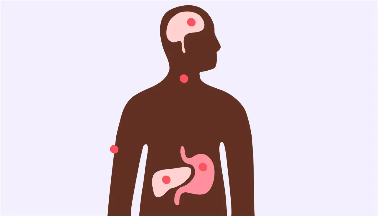 Illustration av en m&auml;nniska med markerade organ som hj&auml;rna, hals, mage och lever. R&ouml;da prickar indikerar var stress kan p&aring;verka kroppen, och visar att kan man f&aring; feber av stress.